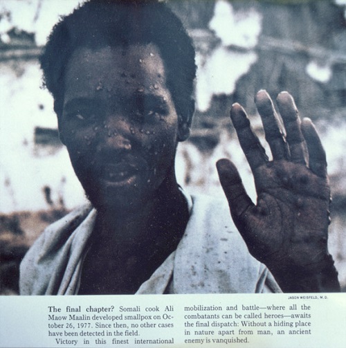 1977 yılındaki son çiçek hastalığı somali