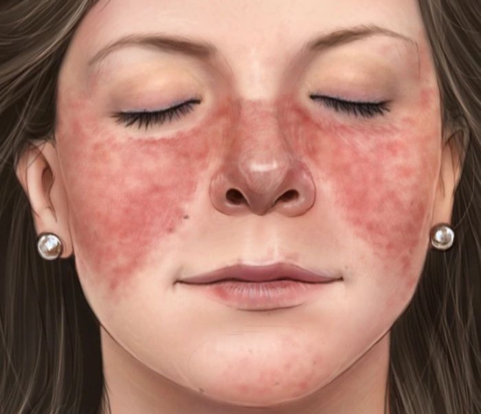 lupus (kelebek hastalığı) olmuş bir kadın yüzünün çizimi