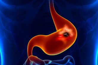 Gastrit nedir? Belirtileri, tedavisi, ilaçları ve diyeti