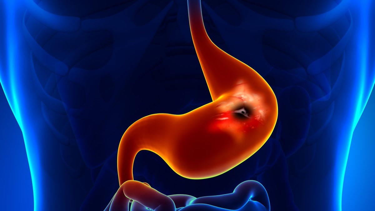 Gastrit nedir? Belirtileri, tedavisi, ilaçları ve diyeti