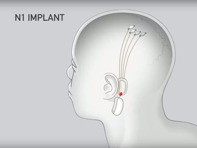 neuralink implantı