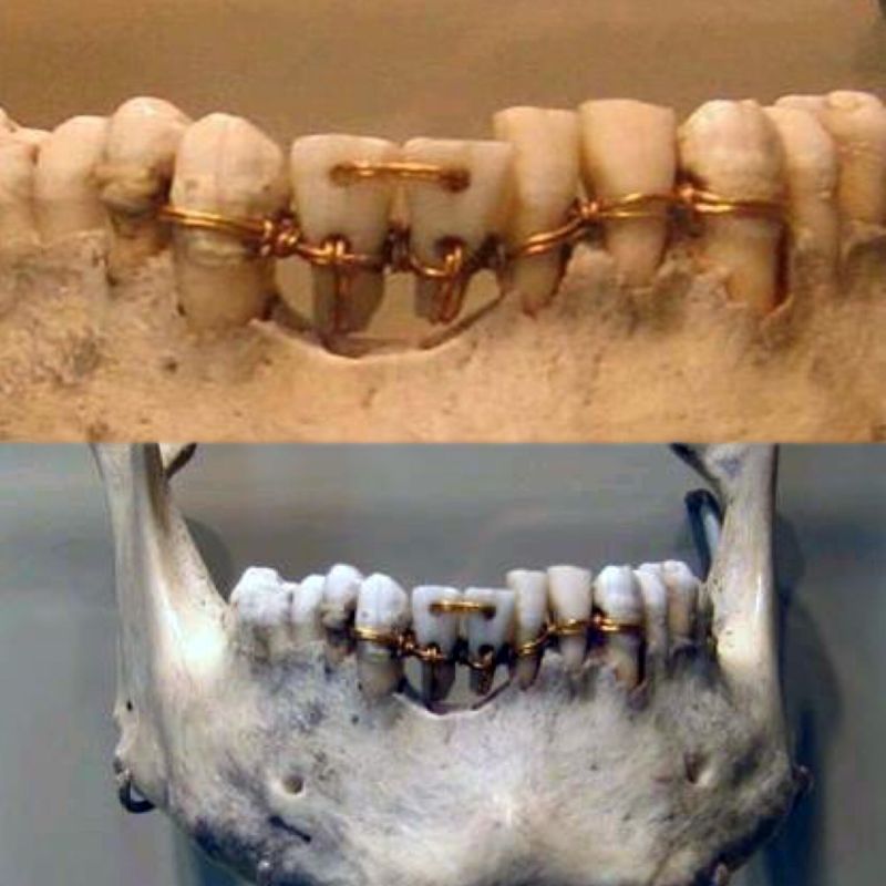 Antik Mısır'da Diş Protezleri