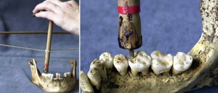 Antik Mısır'da Çürük ve Diş Eti Tedavisi