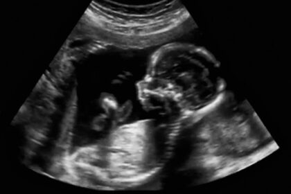 ultrason görüntüsü