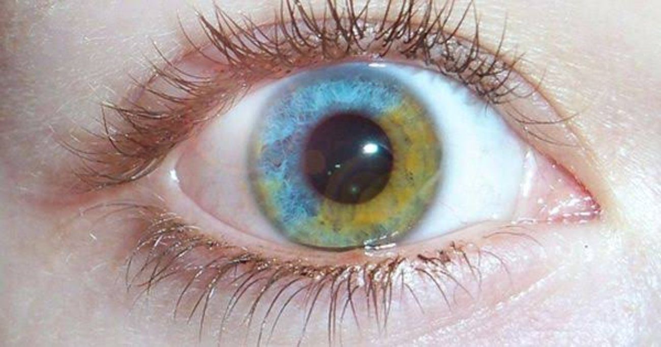 Parçalı heterokromiye sahip bir göz.