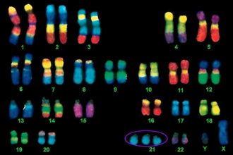 chromosome Intelligence boost for Down patients