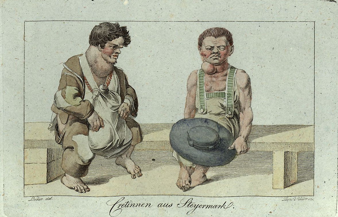 Kretinizm (Steiermark), bakır gravür, 1815. Kaynak: Franz Sartori - Sartori, Franz (1819