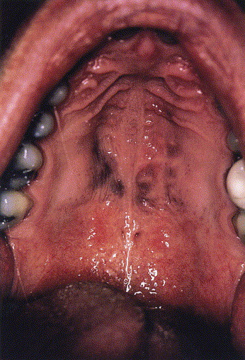 Minosiklin tedavisine bağlı oral mukozal pigmentasyon: