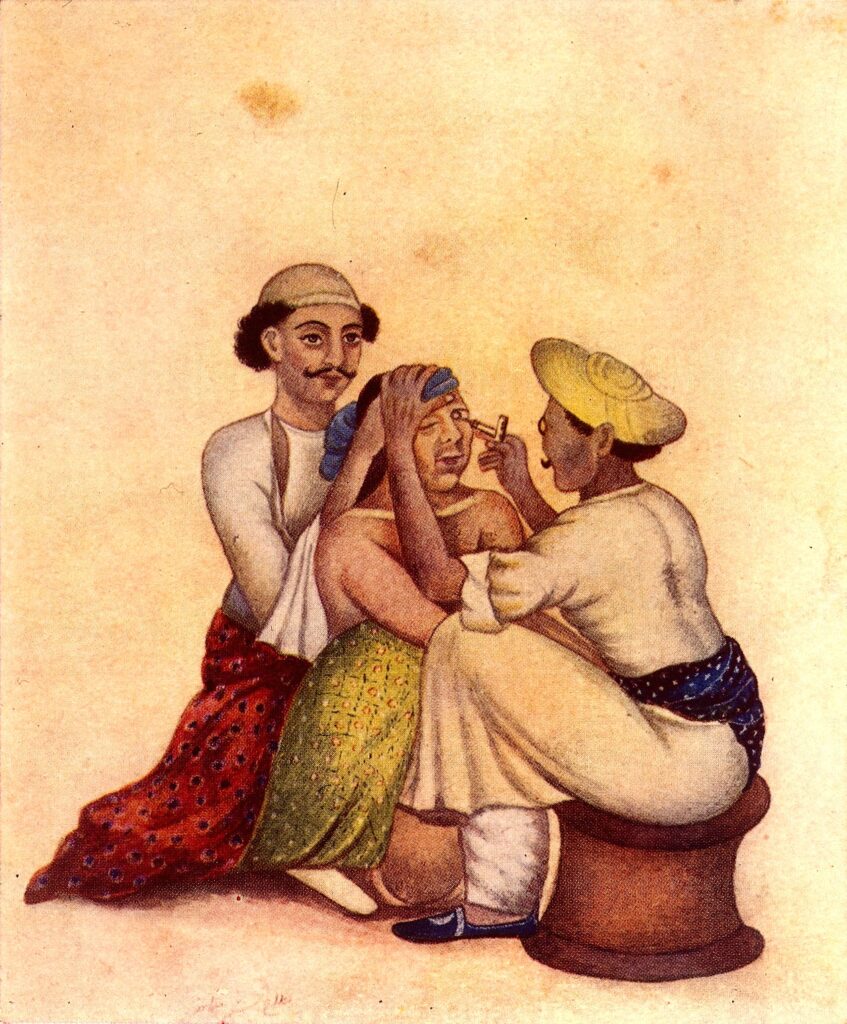 Katarakt ameliyatı; Wellcome Koleksiyonu'ndan tekniği uygulayan Hintli doktorları gösteren bir illüstrasyon.