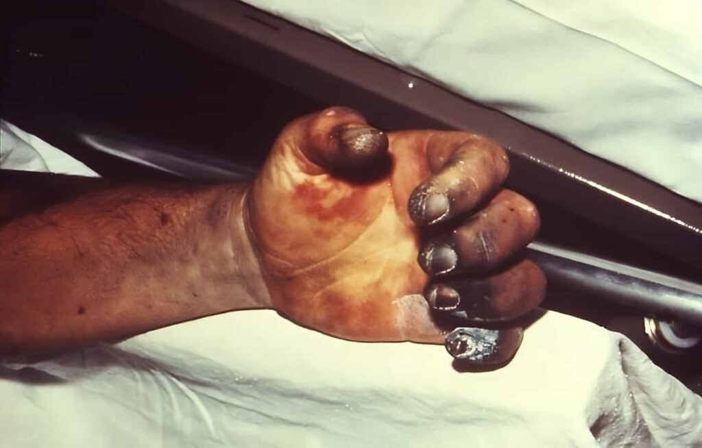 Yersinia pestis enfeksiyonunun bir özelliği de elin nekrozudur. (Fotoğraf 1975 veba salgını kurbanından).