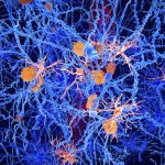 Mikroglia (kırmızı renkte) Alzheimer