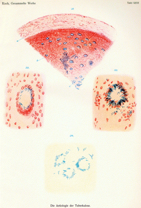 Koch'un 1882'de tüberküloz basili çizimi (Die Ätiologie der Tuberkulose'dan)