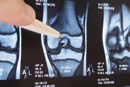 Osteoartritli bir dizin diyagramı